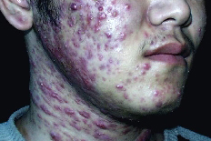 青春痘严重时症状二 破溃痊愈后,可遗留暂时色素沉着或有轻度凹陷的
