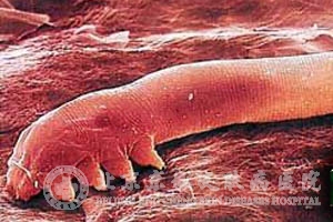 毛囊虫皮炎的检查方法