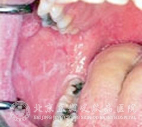 口腔扁平苔藓疾病分类