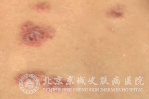 痈的发病原因是什么