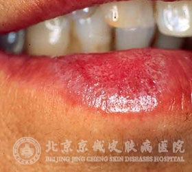 多年的口腔扁平苔藓能治好吗