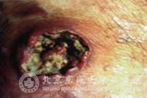 放射性皮炎的程度分类