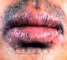 剥脱性唇炎在临床上分为几种类型