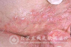 从生殖疱疹症状图可以看出生殖疱疹症状:皮损多发于男性的包皮,龟头