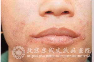 青春痘根据病因的分类