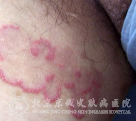 根据体股癣的症状图片认识体股癣