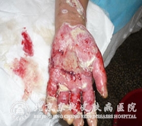 疤痕疙瘩有什么较新诊疗