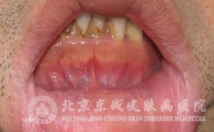 ⻯Դ(actiniccheilitis)Ʒʲô