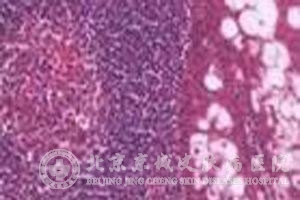 皮脂腺囊肿是什么病