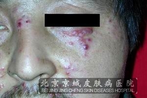 红斑狼疮能活多长时间