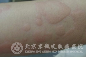 风疹和麻疹区别在哪里_风疹_北京京城皮肤病医院(北京
