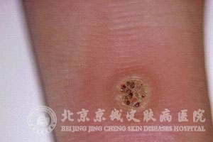 千日疮积极治疗很关键_寻常疣_北京京城皮肤病医院
