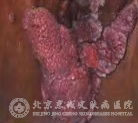 尖锐湿疣的病史
