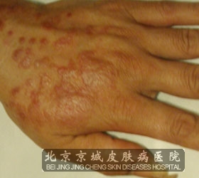 疣状扁平苔藓怎么治疗