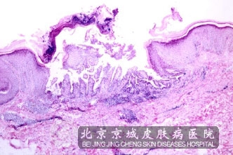 �½�ʪ���ͷ��ܾ��������֢״