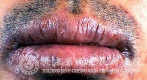剥脱性唇炎症状是什么