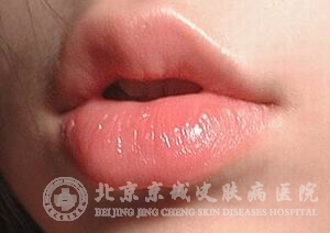 ⻯Դ(actinic cheilitis)֢״ʲô