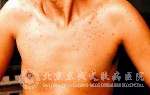 糠秕孢子菌症状