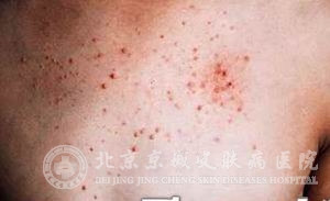 糠秕孢子菌如何鉴别诊断
