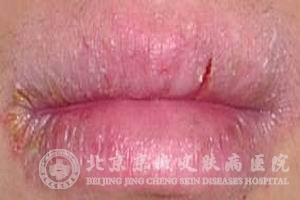 Դ(chronic cheilitis)ĲЩ