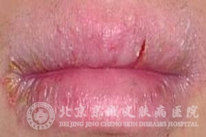 Դ(chronic cheilitis)ĲЩ