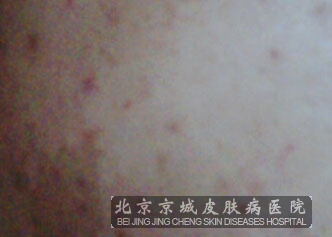 α