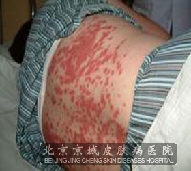 红斑狼疮水肿怎样护理呢_红斑狼疮_北京京城皮肤病