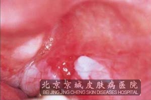 黏膜疾病症状图片