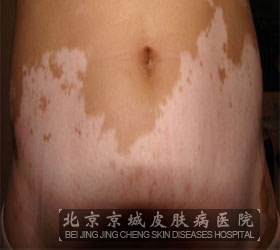 什么是肛门部位白癜风