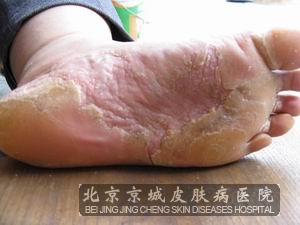 水疱型香港脚的外治诊疗