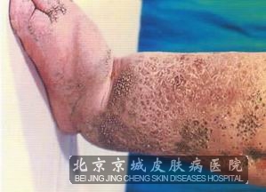 鳞屑型香港脚的外治诊疗