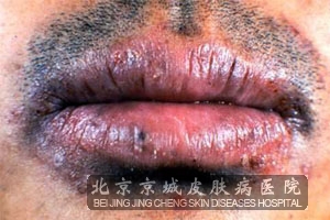 剥脱性唇炎的临床表现