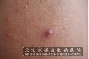 肾痈发病有什么症状特点