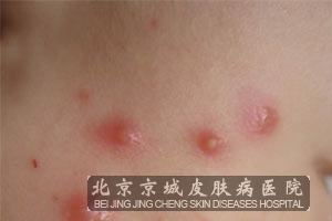 皮肤结核病医生推荐