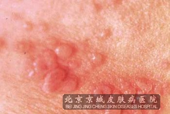 生殖器疱疹危害