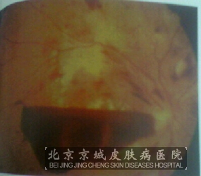 性病性型淋巴肉芽肿的危害_淋病性肉芽肿_北京京城病