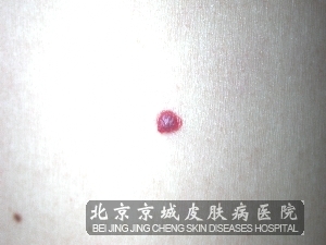 皮肤表面,形状不规则,在生长过程上也和草莓状血管瘤很接近,在较开始