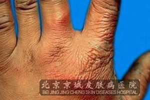 怎么治疗接触性皮炎