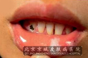 口腔哪些部位的白斑容易癌变