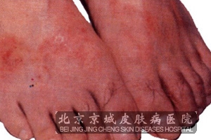 接触性皮炎的鉴别诊断
