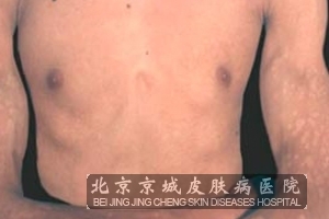 花斑癣怎么治疗