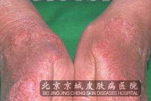 接触性皮炎的病因是什么