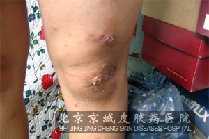 怎样预防异位性皮炎复发