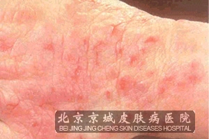 异位性皮炎是什么原因引起的