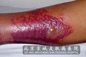 丹毒属于病毒感染吗