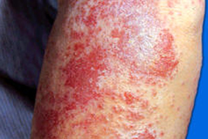 传染性湿疹样皮炎的特点是什么