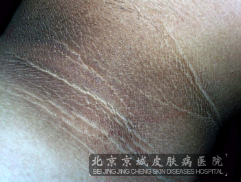 假性黑棘皮症的治疗