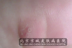 寻常疣和尖锐湿疣的鉴别