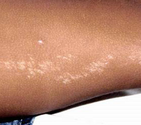 皮肤病大全 红斑鳞屑性皮肤病 苔癣    多发线状苔藓症状图片有什么?