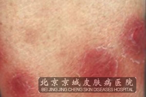 硬红斑应该怎样预防